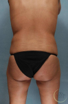 Liposuction Case 55 Before